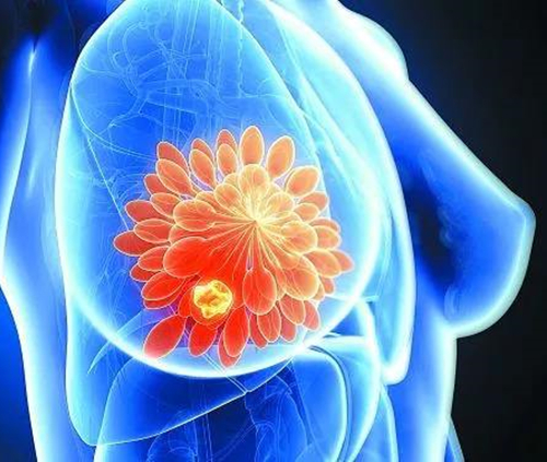 乳房不对称与乳腺癌风险增加有关