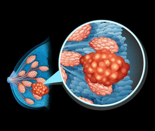 新型精准癌症药物Datopotamab Deruxtecan有望治疗三阴性乳腺癌