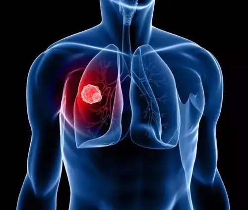 临床招募:转移性非小细胞肺癌用药Ociperlimab注射液