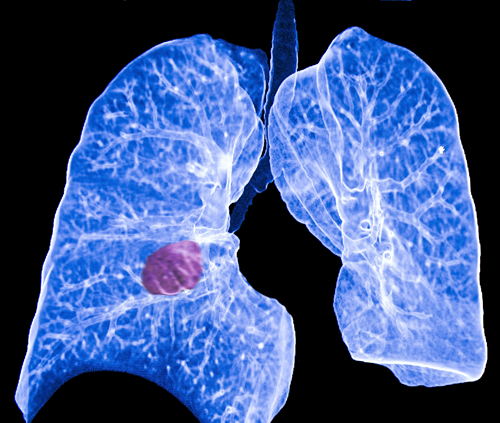 HSK40118片治疗EGFR突变的晚期非小细胞肺癌患者的临床招募