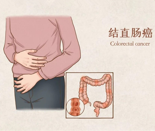 去日本看病注意的问题及结肠直肠癌如何治疗？